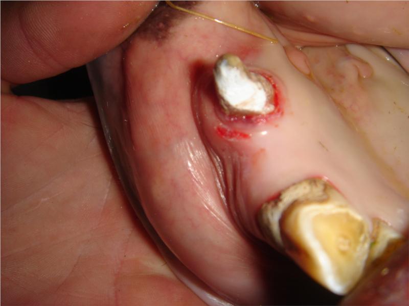Hingstetand med tandkødsbetændelse efter fjernelse af plak