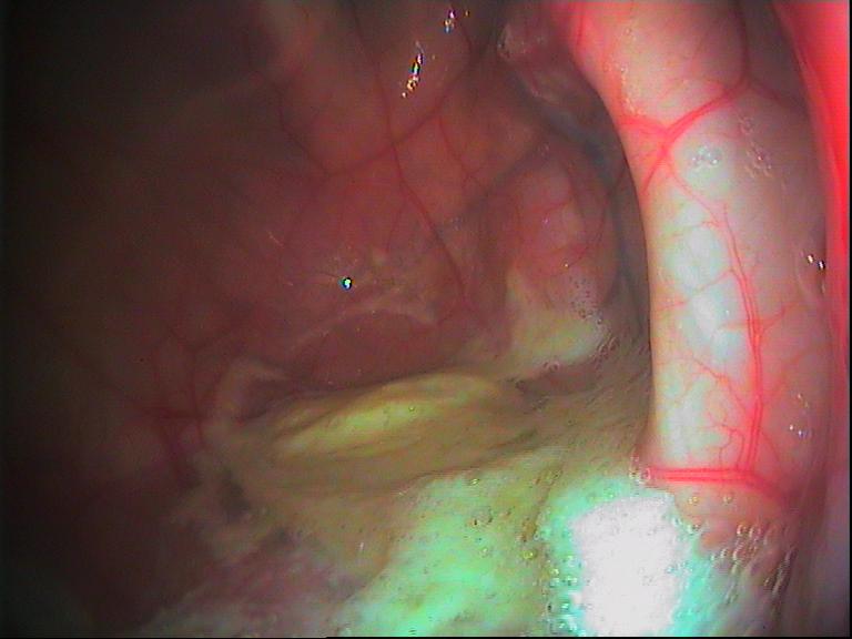 Endoskopibillede af luftposen på et føl med luftvejsinfektion gennem længere tid. Der ses en stor ansamling af pus.